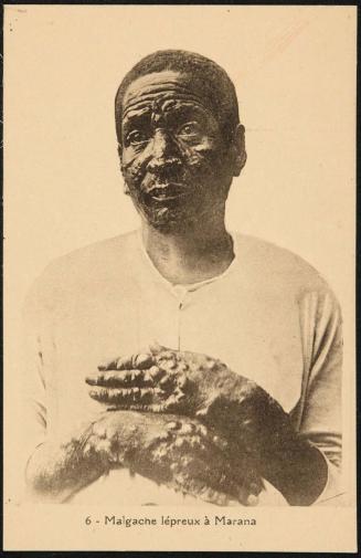 Malgache lépreux à Marana