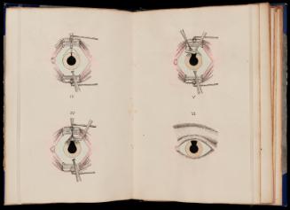 Opérations des yeux