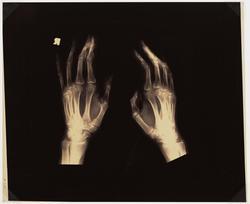 #26 (hand x-rays)